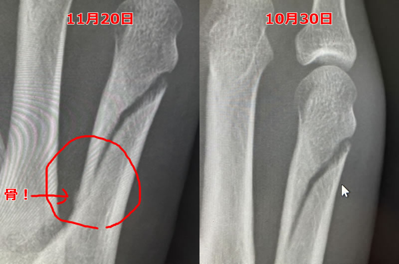 骨折の治り具合、前回との比較