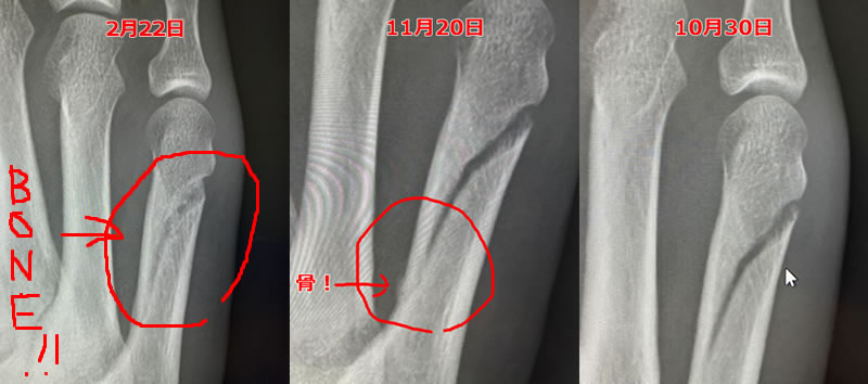 10月から2月までの骨の修復過程